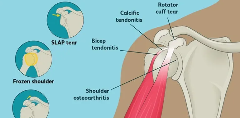 “Is it my neck or my shoulder?” It is often hard to tell….