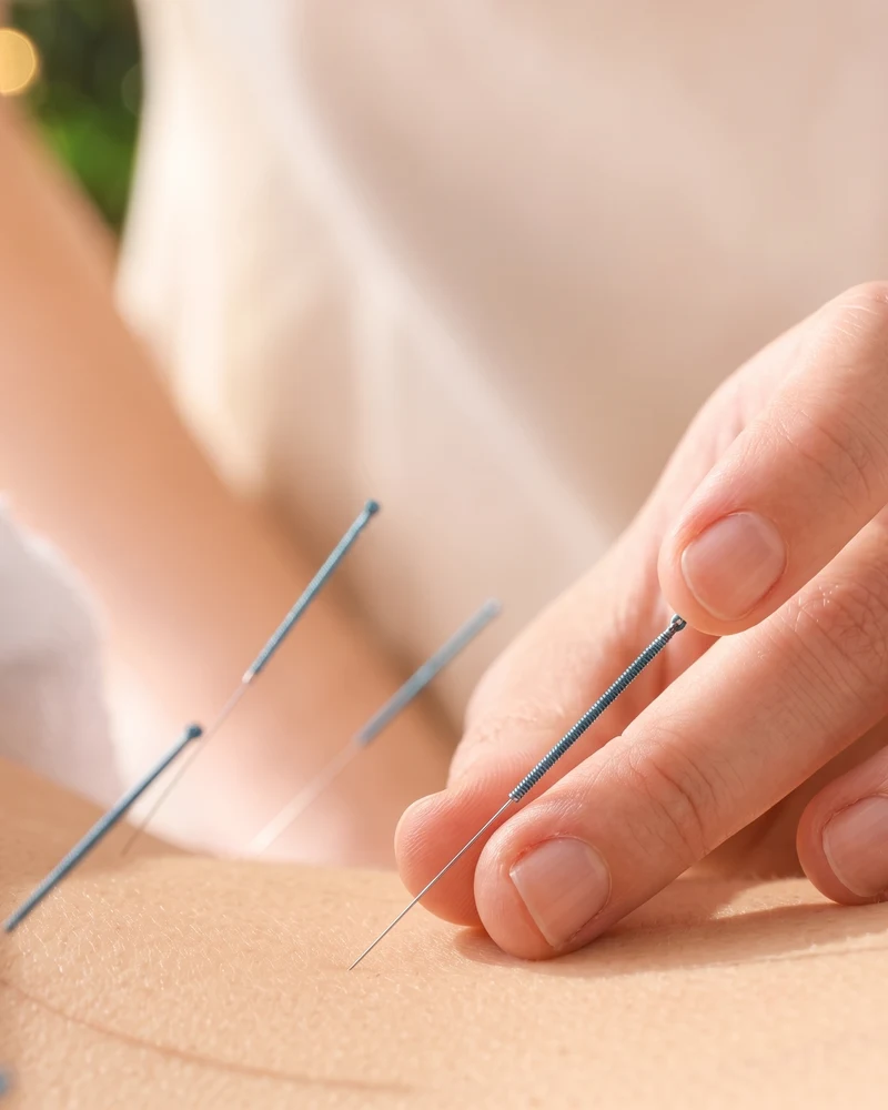 acupuncture at Universus Physical Therapy & Wellness