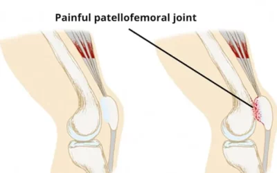 Patellofemoral Pain Syndrome a.k.a. Knee Pain